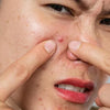 Battling Acne and; Skin Irritation During Monsoon: Skincare Switch Tips You Need