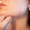 Best Products for Hormonal Acne in Adults: What Really Works in 2025?