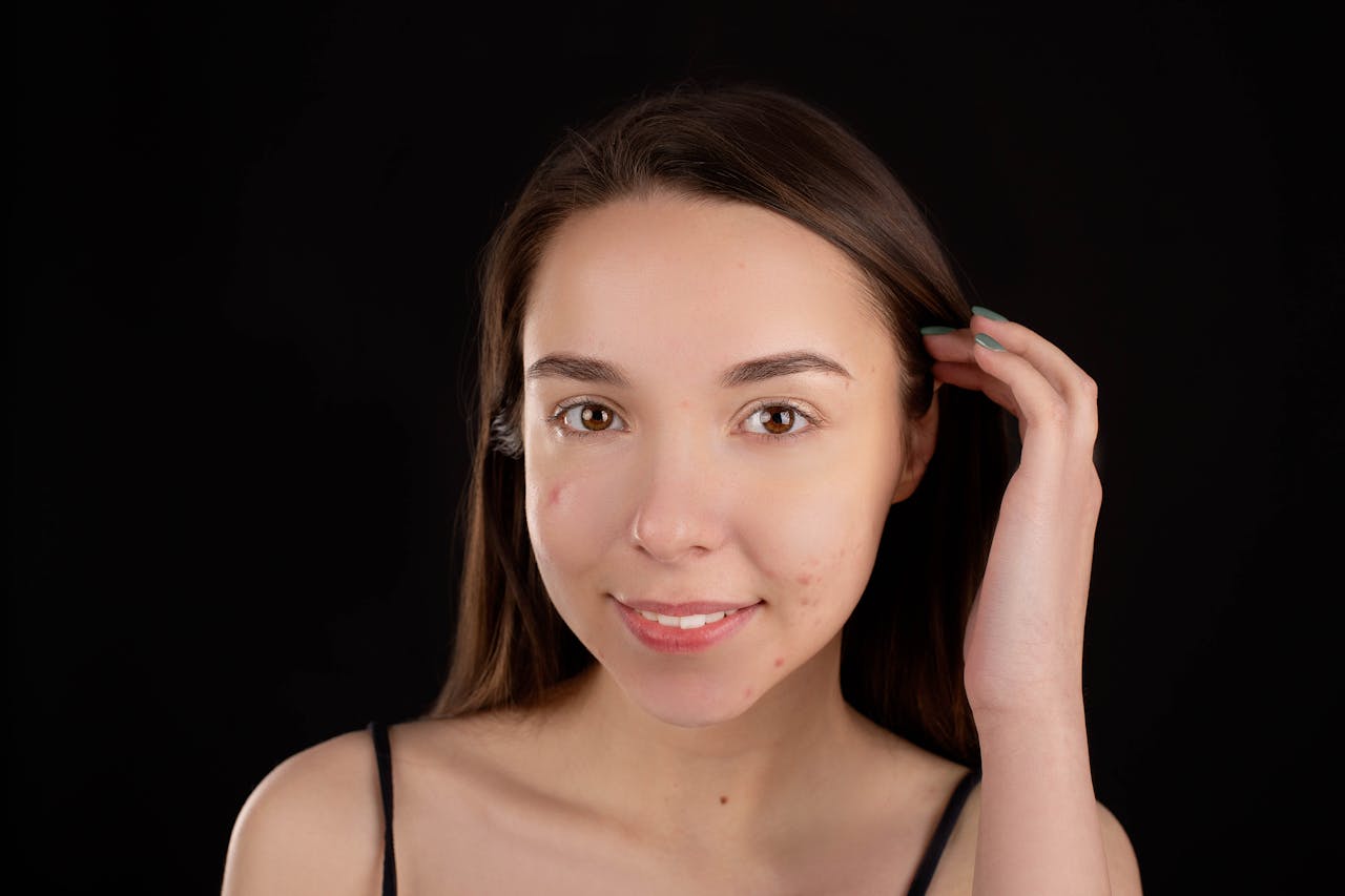 Benzoyl Peroxide and Adapalene Gel: The Power Duo for Acne-Free Skin in 2025