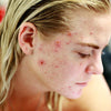 Acne vs Fungal Acne: Key Differences, Causes & Treatments in India
